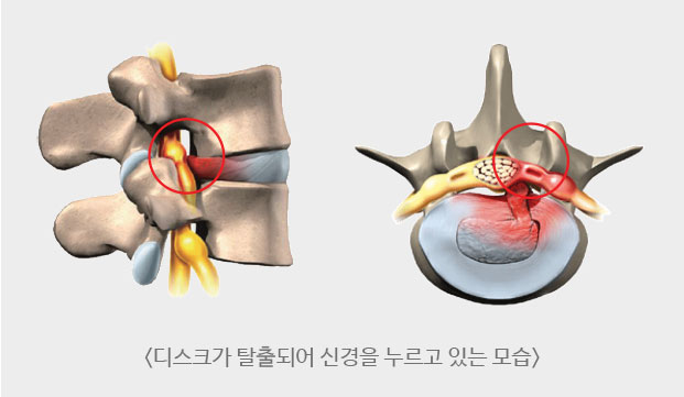 디스크가 탈출되어 신경을 누르고 있는 모습