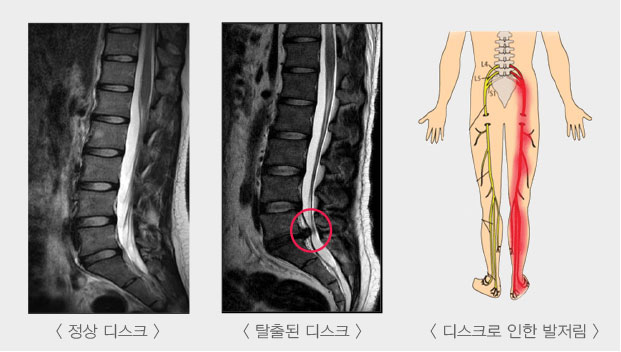 허리디스크의 주요증상