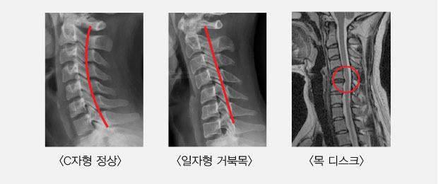 거북목증후군 모습