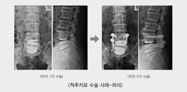 척추치료 수술 사례-허리