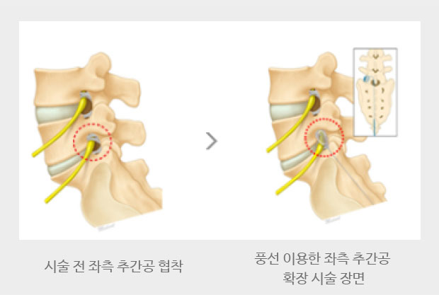 시술 전 좌측 추간공 협착, 풍선 이용한 좌측 추간공 확장 시술 장면